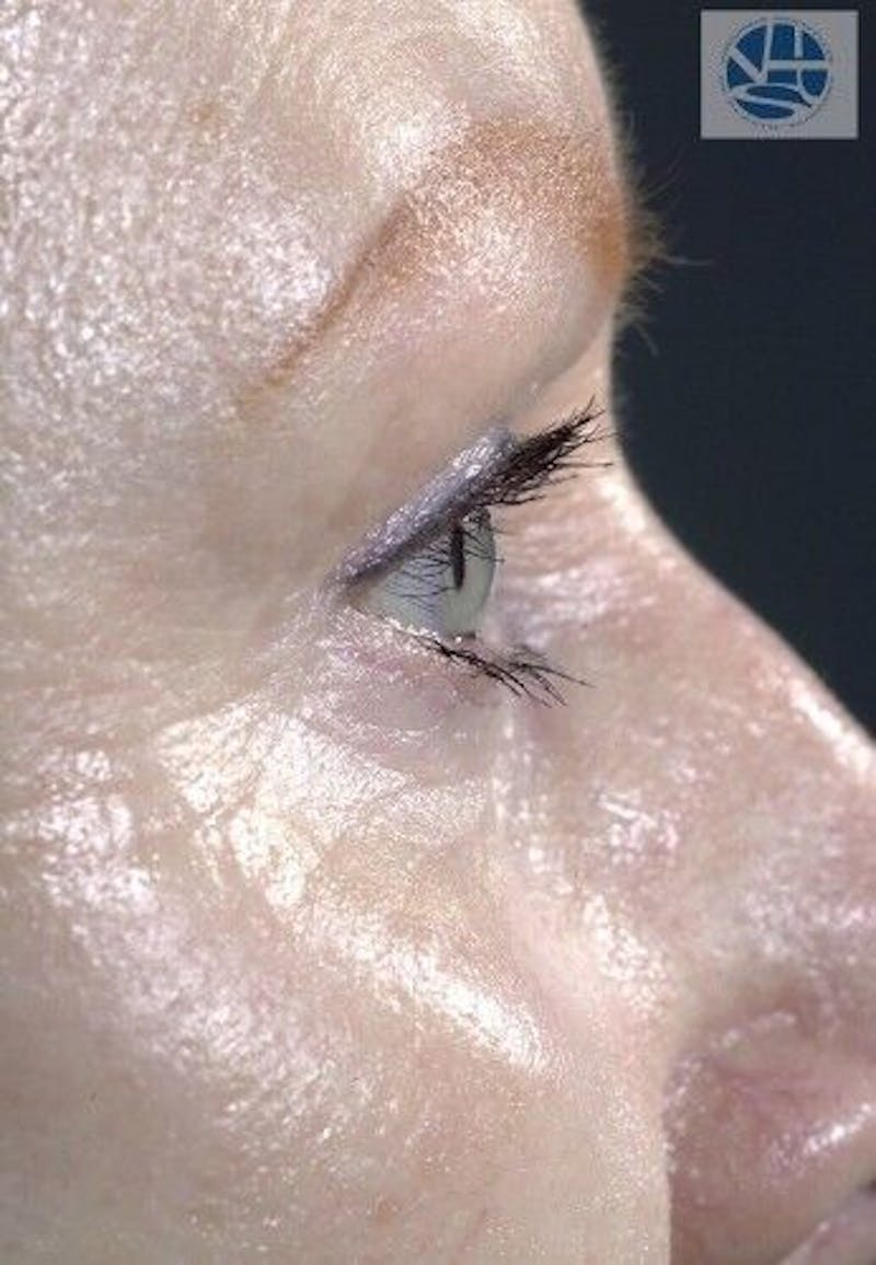CO2 Laser Before & After Gallery - Patient 55343146 - Image 10