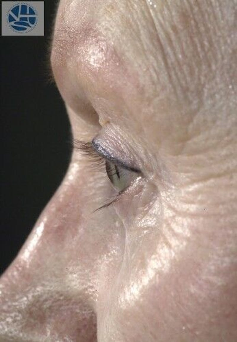 CO2 Laser Before & After Gallery - Patient 55343146 - Image 11
