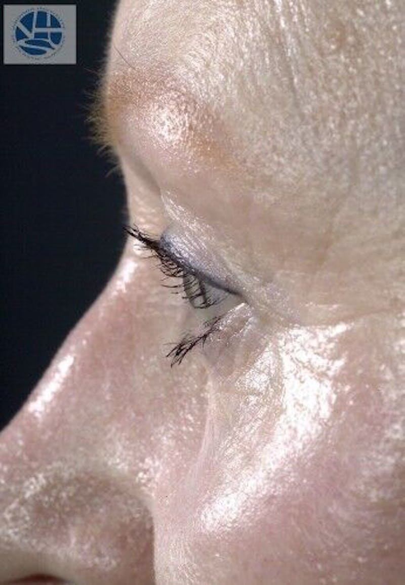 CO2 Laser Before & After Gallery - Patient 55343146 - Image 12