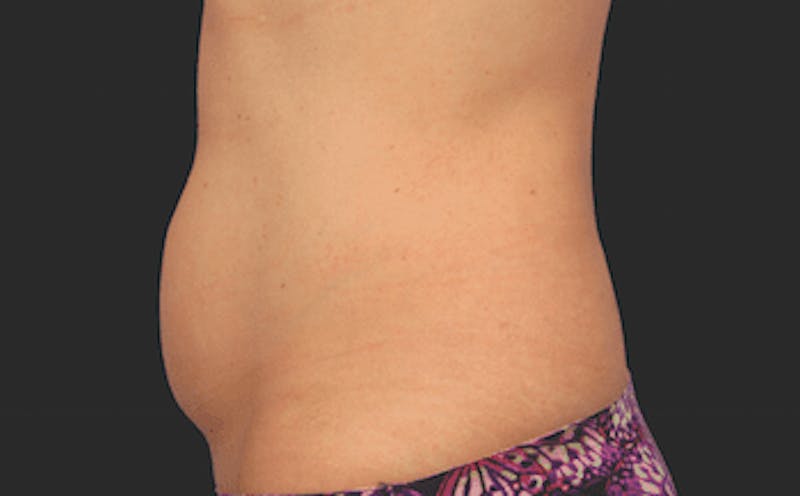 CoolSculpting Before & After Gallery - Patient 55344770 - Image 1