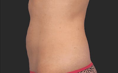 CoolSculpting Gallery - Patient 55344770 - Image 2