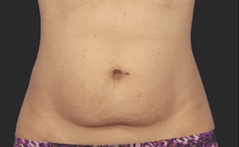 CoolSculpting Before & After Gallery - Patient 55344772 - Image 1
