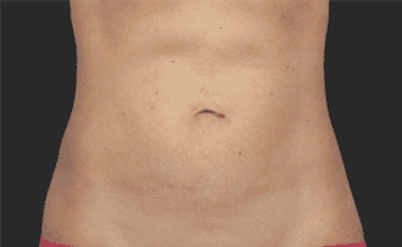 CoolSculpting Before & After Gallery - Patient 55344772 - Image 2