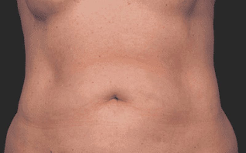 CoolSculpting Before & After Gallery - Patient 55344774 - Image 1