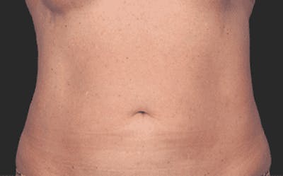 CoolSculpting Before & After Gallery - Patient 55344774 - Image 2