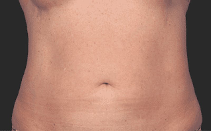 CoolSculpting Before & After Gallery - Patient 55344774 - Image 2