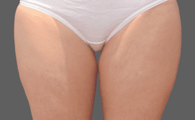 CoolSculpting Before & After Gallery - Patient 55344775 - Image 1