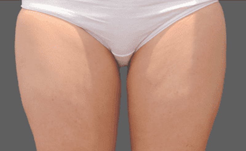 CoolSculpting Before & After Gallery - Patient 55344775 - Image 2