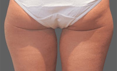 CoolSculpting Before & After Gallery - Patient 55344776 - Image 1