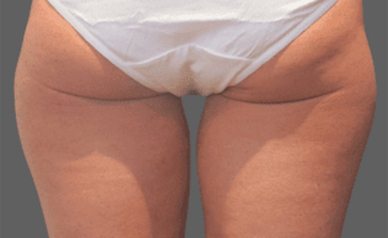 CoolSculpting Before & After Gallery - Patient 55344776 - Image 1