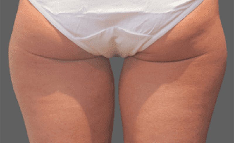 CoolSculpting Before & After Gallery - Patient 55344776 - Image 1