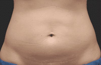 CoolSculpting Before & After Gallery - Patient 55344778 - Image 1