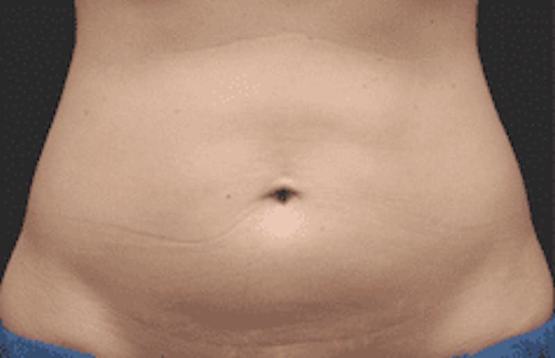 CoolSculpting Before & After Gallery - Patient 55344778 - Image 1