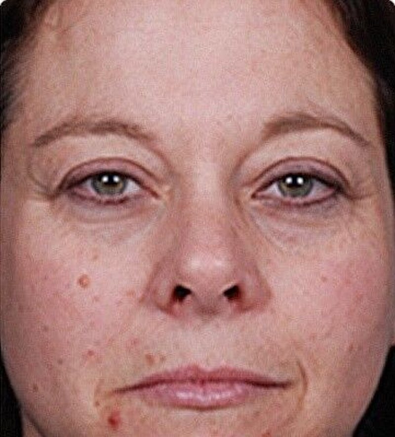 Facial Peel Before & After Gallery - Patient 55344779 - Image 1