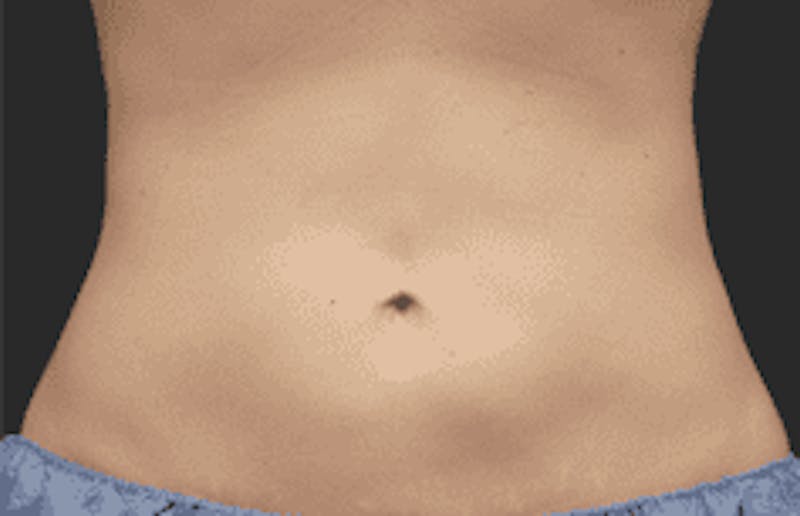 CoolSculpting Before & After Gallery - Patient 55344778 - Image 2
