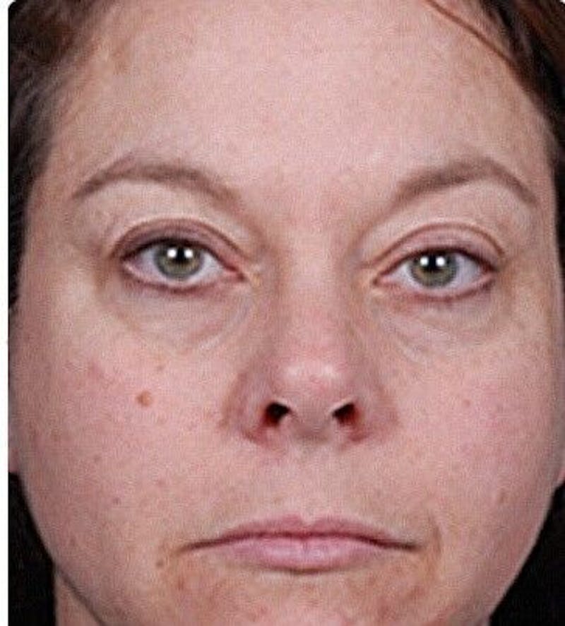 Facial Peel Before & After Gallery - Patient 55344779 - Image 2