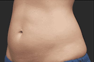 CoolSculpting Before & After Gallery - Patient 55344780 - Image 1