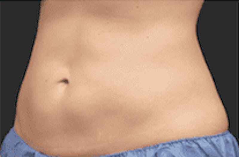 CoolSculpting Before & After Gallery - Patient 55344780 - Image 2