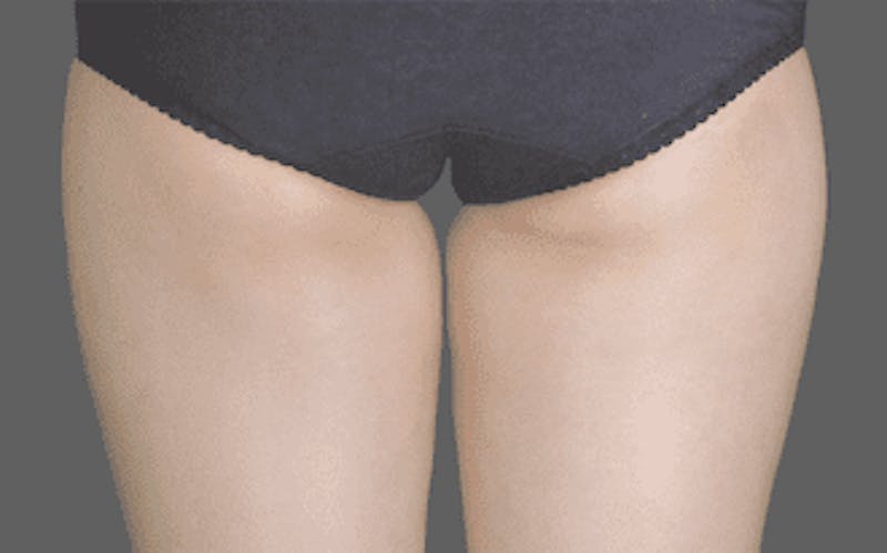 CoolSculpting Before & After Gallery - Patient 55344783 - Image 1