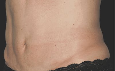 CoolSculpting Before & After Gallery - Patient 55344787 - Image 2