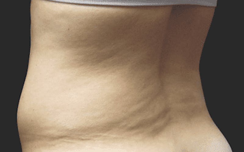 CoolSculpting Before & After Gallery - Patient 55344789 - Image 1