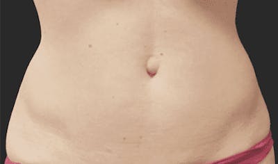 CoolSculpting Before & After Gallery - Patient 55344792 - Image 1