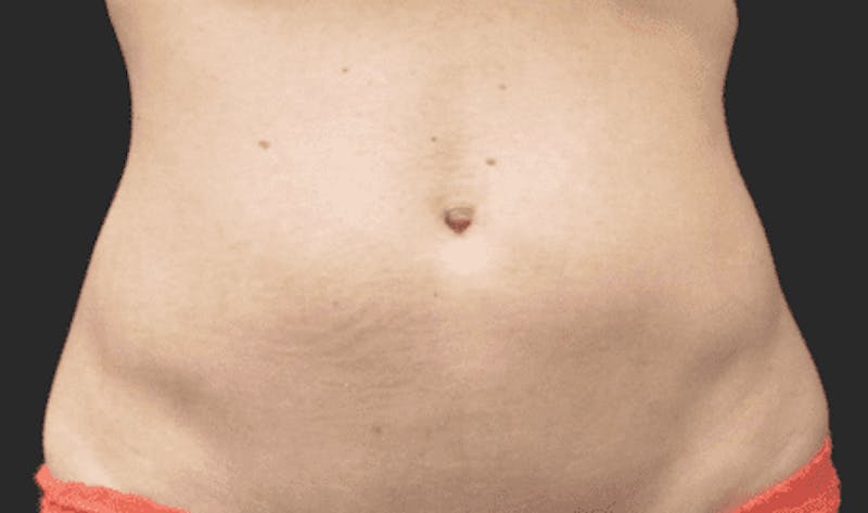 CoolSculpting Before & After Gallery - Patient 55344792 - Image 2