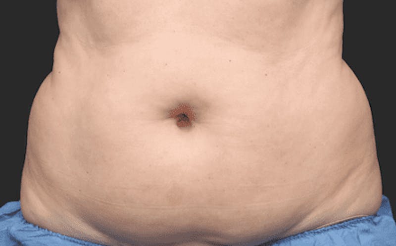 CoolSculpting Before & After Gallery - Patient 55344794 - Image 1
