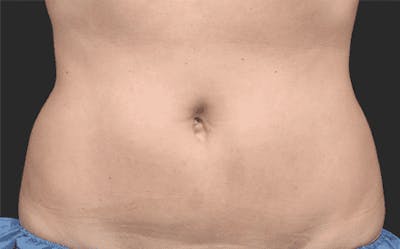CoolSculpting Gallery - Patient 55344794 - Image 2