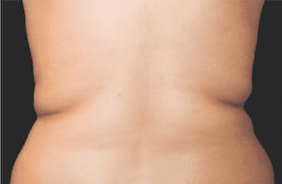 CoolSculpting Before & After Gallery - Patient 55344796 - Image 1