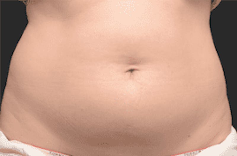 CoolSculpting Gallery - Patient 55344799 - Image 1