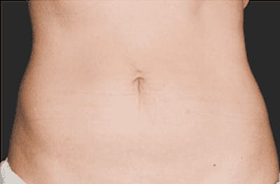 CoolSculpting Before & After Gallery - Patient 55344799 - Image 2