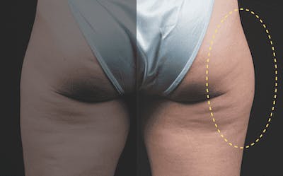 CoolSculpting Before & After Gallery - Patient 55344802 - Image 1