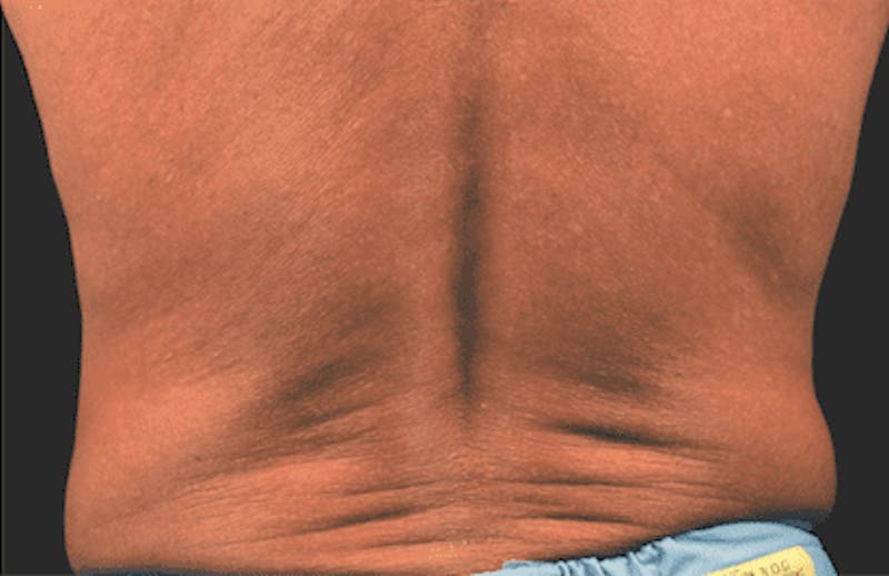 CoolSculpting Before & After Gallery - Patient 55344803 - Image 1