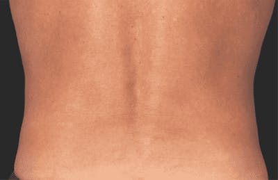 CoolSculpting Before & After Gallery - Patient 55344803 - Image 2