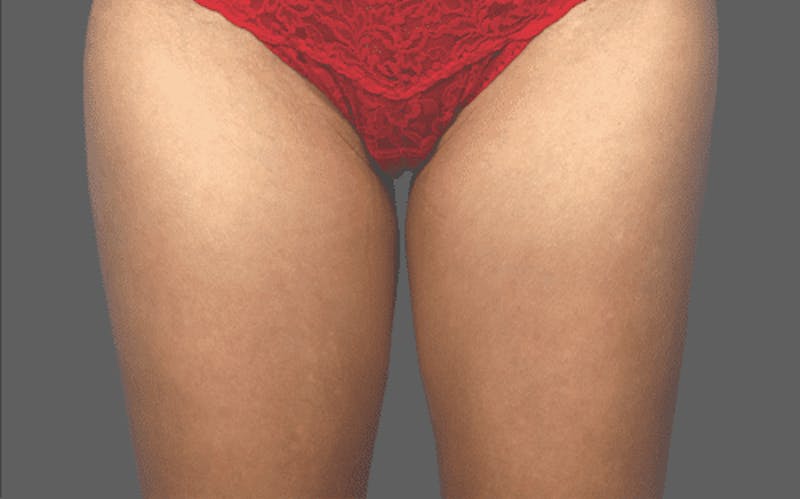 CoolSculpting Before & After Gallery - Patient 55344804 - Image 1