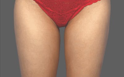 CoolSculpting Before & After Gallery - Patient 55344804 - Image 2