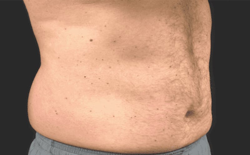 CoolSculpting Before & After Gallery - Patient 55344806 - Image 1