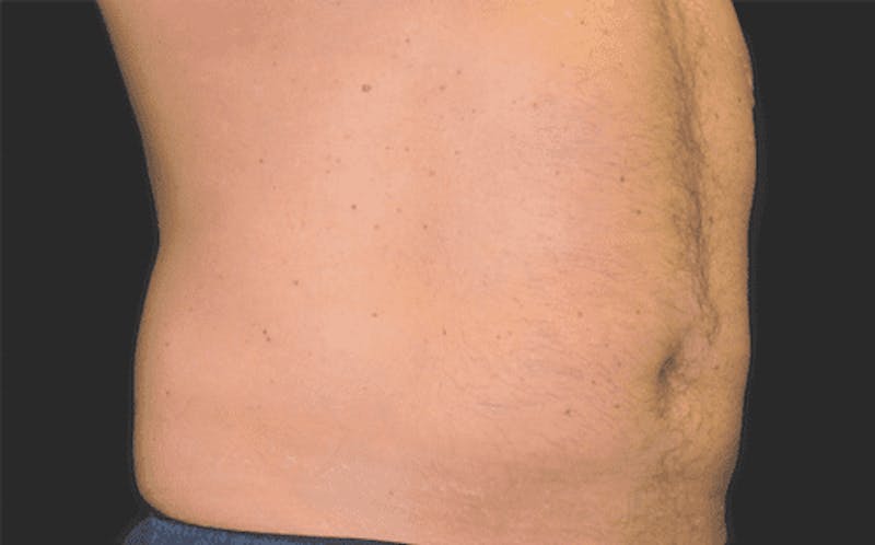 CoolSculpting Before & After Gallery - Patient 55344806 - Image 2