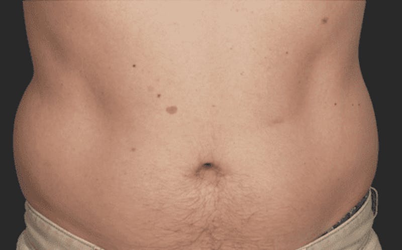 CoolSculpting Before & After Gallery - Patient 55344809 - Image 1