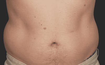CoolSculpting Before & After Gallery - Patient 55344809 - Image 1