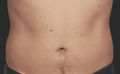 CoolSculpting Before & After Gallery - Patient 55344809 - Image 2