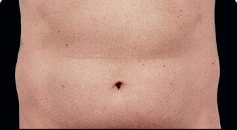 CoolSculpting Before & After Gallery - Patient 55344810 - Image 1