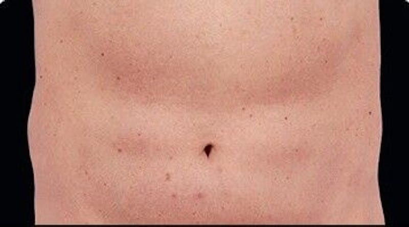 CoolSculpting Before & After Gallery - Patient 55344810 - Image 2