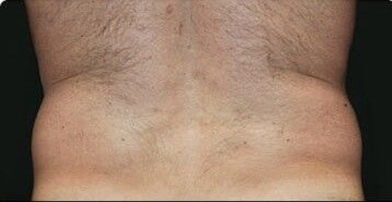 CoolSculpting Before & After Gallery - Patient 55344812 - Image 1