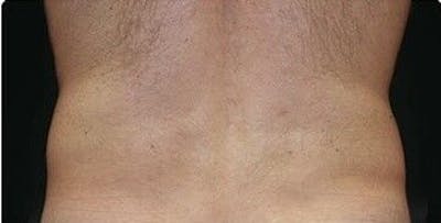 CoolSculpting Before & After Gallery - Patient 55344812 - Image 2