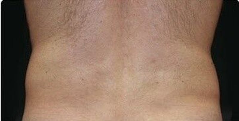 CoolSculpting Before & After Gallery - Patient 55344812 - Image 2