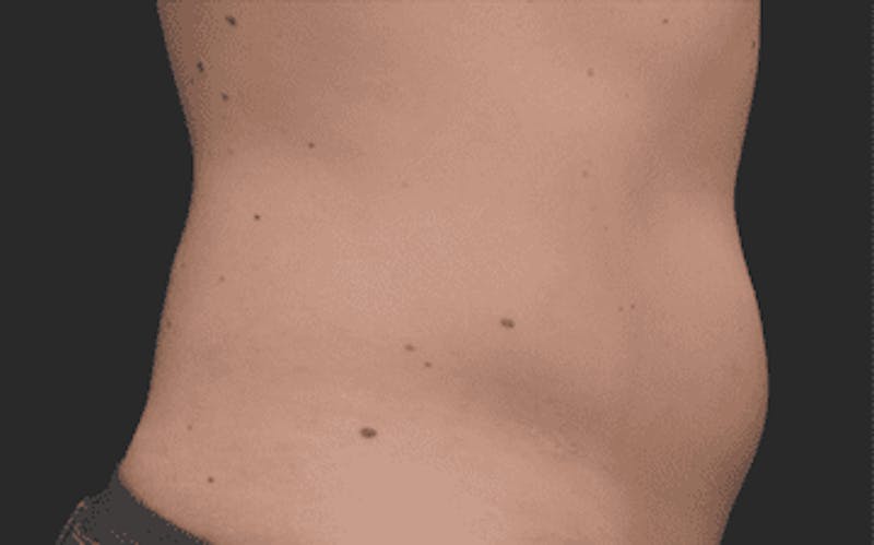 CoolSculpting Before & After Gallery - Patient 55344815 - Image 1