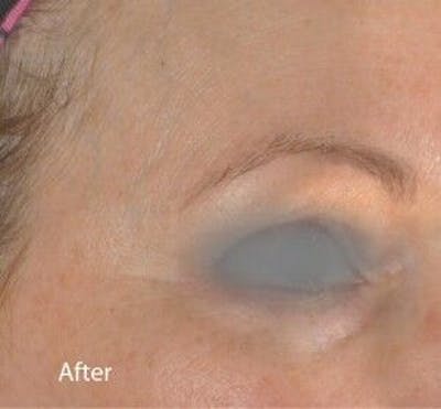 Infini Genius Before & After Gallery - Patient 55344814 - Image 2