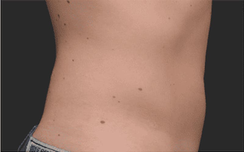CoolSculpting Before & After Gallery - Patient 55344815 - Image 2